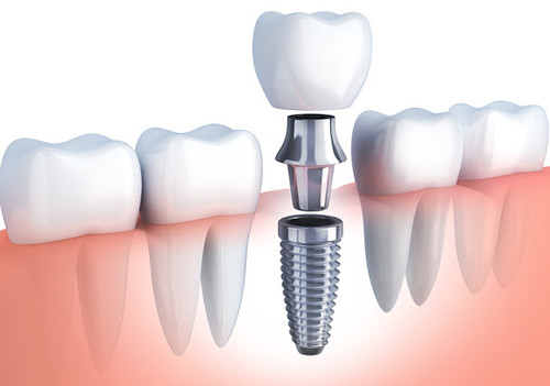 Искусственные корни зубов: как выбрать импланты 